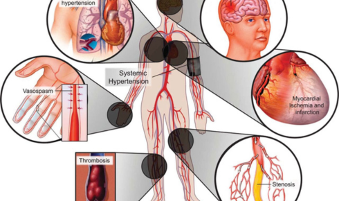Humacyte’s AV Access Study shows promising results