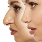 rhinoplasty in bangalore