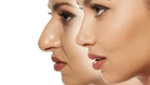 rhinoplasty in bangalore