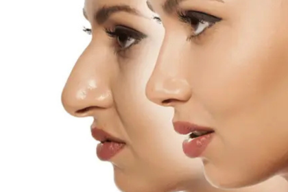 rhinoplasty in bangalore
