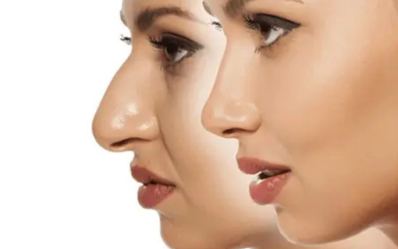 rhinoplasty in bangalore